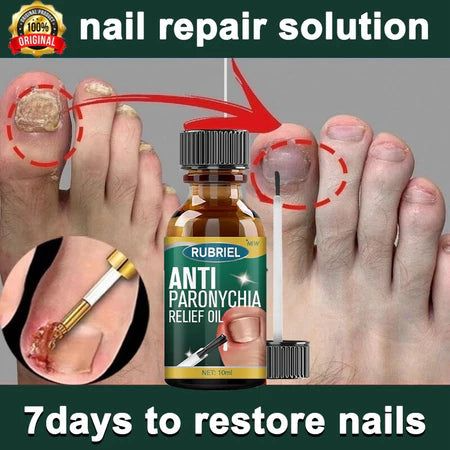Anti Paronychia Relief Oil – Buy 1 Get 1 FREE 🔥 (முழுமையான நக பராமரிப்பு தீர்வு)