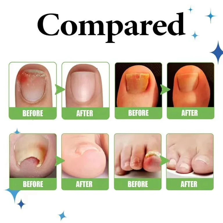Anti Paronychia Relief Oil – Buy 1 Get 1 FREE 🔥 (முழுமையான நக பராமரிப்பு தீர்வு)