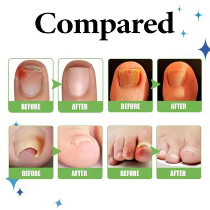 Anti Paronychia Relief Oil – Buy 1 Get 1 FREE 🔥 (முழுமையான நக பராமரிப்பு தீர்வு)