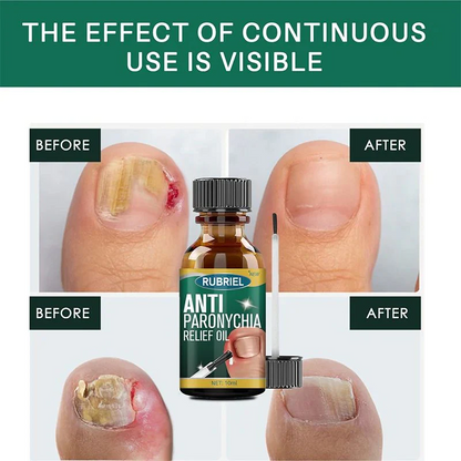 Anti Paronychia Relief Oil - (Buy 1 Get 1 FREE🔥🔥)