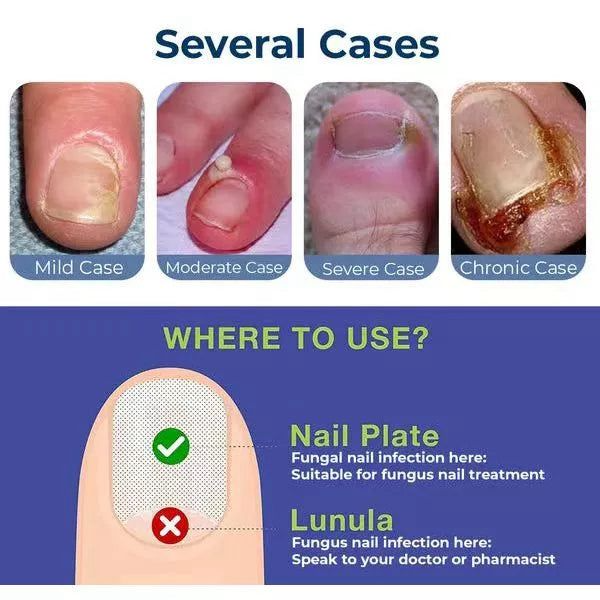 Anti Paronychia Relief Oil - (Buy 1 Get 1 FREE🔥🔥)