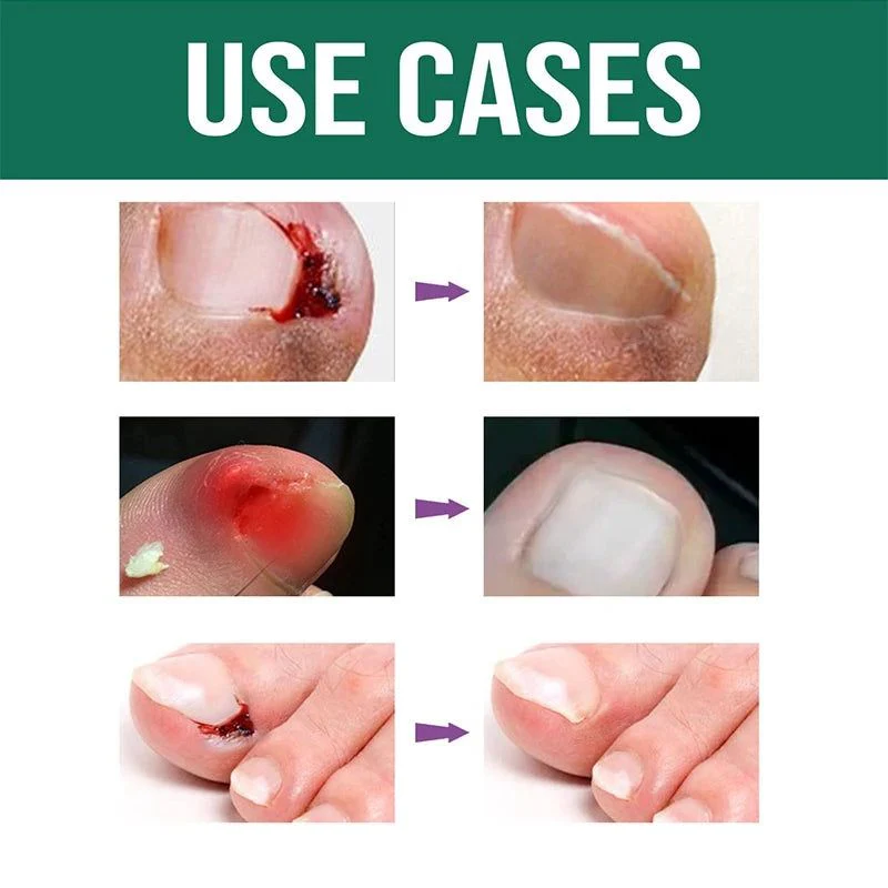 Anti Paronychia Relief Oil – Buy 1 Get 1 FREE 🔥 (முழுமையான நக பராமரிப்பு தீர்வு)