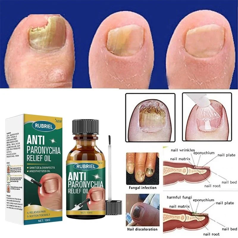 Anti Paronychia Relief Oil – Buy 1 Get 1 FREE 🔥 (முழுமையான நக பராமரிப்பு தீர்வு)